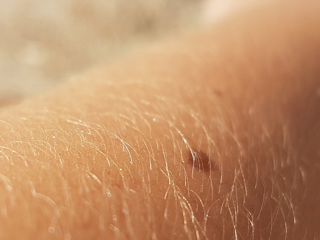 skin tag