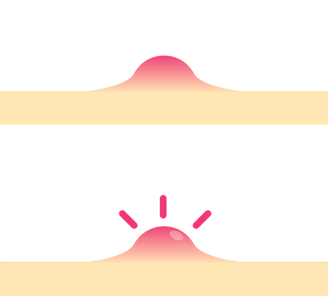 skin tag