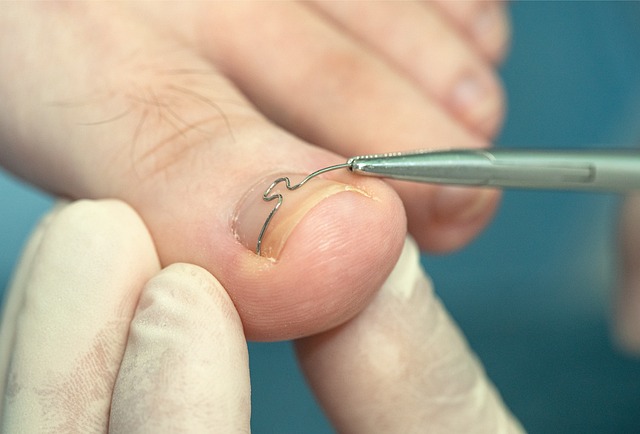 reliable wart removal clinic