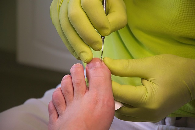 laser wart removal treatment